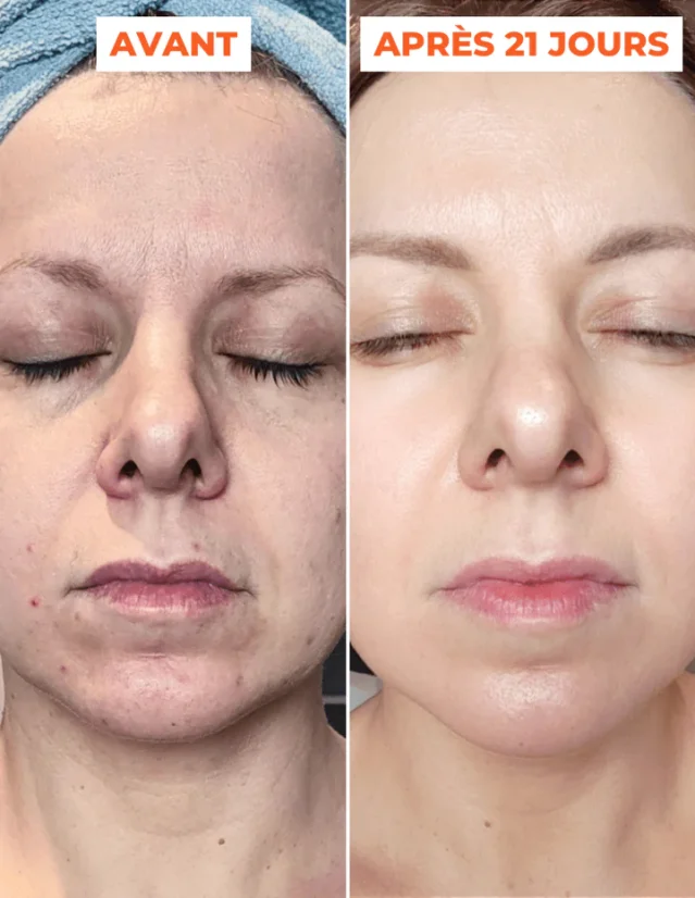 Domácí peeling - DERMEDEN Advanced Peel 2 x 30 ml