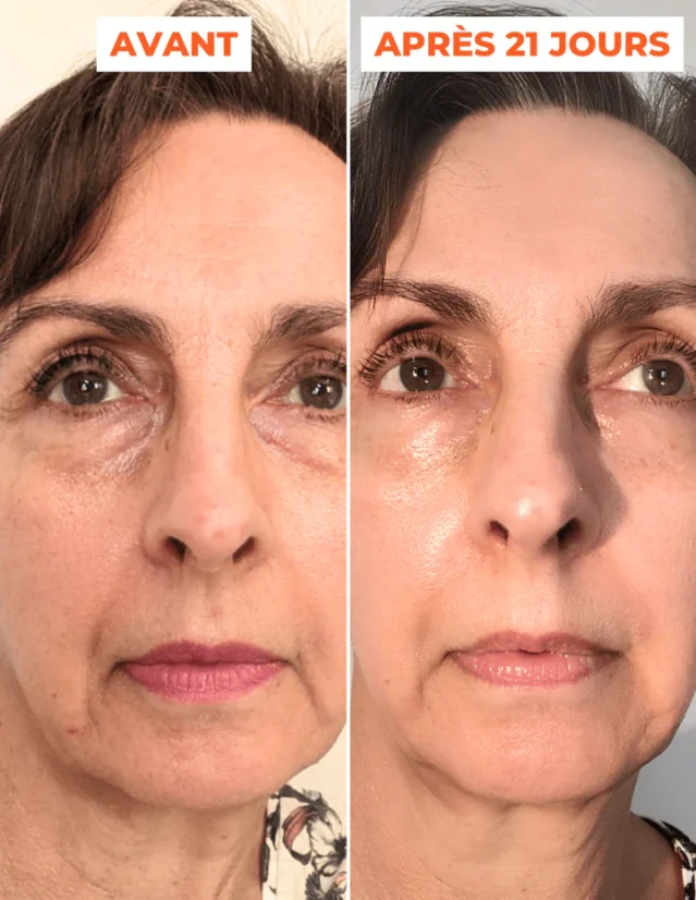 Domácí peeling - DERMEDEN Advanced Peel 2 x 30 ml
