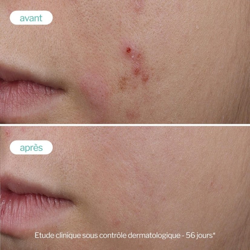 Sérum pro aknózní pleť - NOVEXPERT Trio‑Zinc Serum